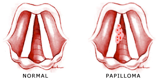 nasal papilloma treatment