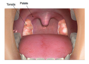 Tonsillectomy For Children: Los Angeles Pediatric ENT