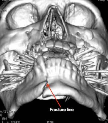 mandible fracture wiring