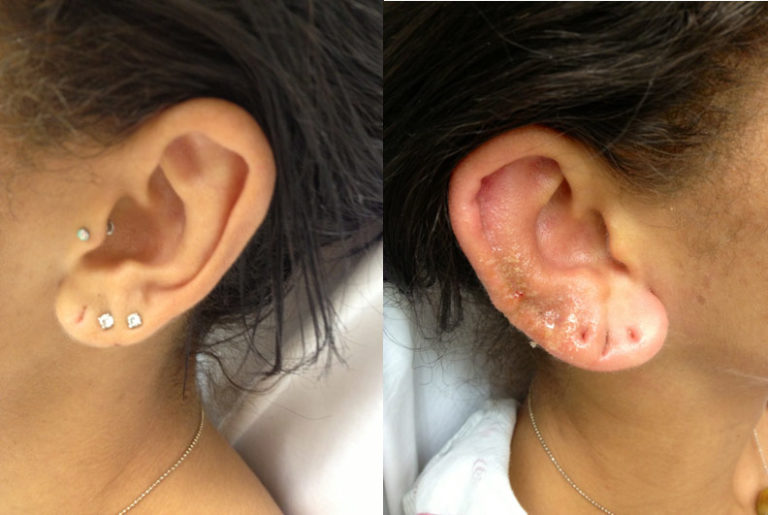 Complications of Ear Piercing Perichondritis and Ear Disfigurement