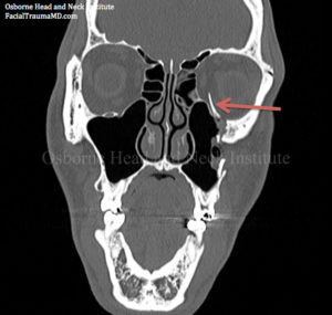 Facial Trauma and Orbital Fracture