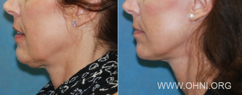 Micro-Mini Lift®: Shorter Recovery Time Than a Facelift