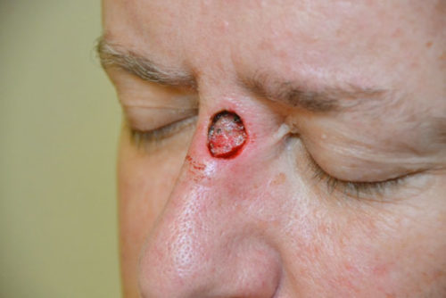 Basal Cell Carcinoma Nasal Bridge Reconstruction Los Angeles Ent